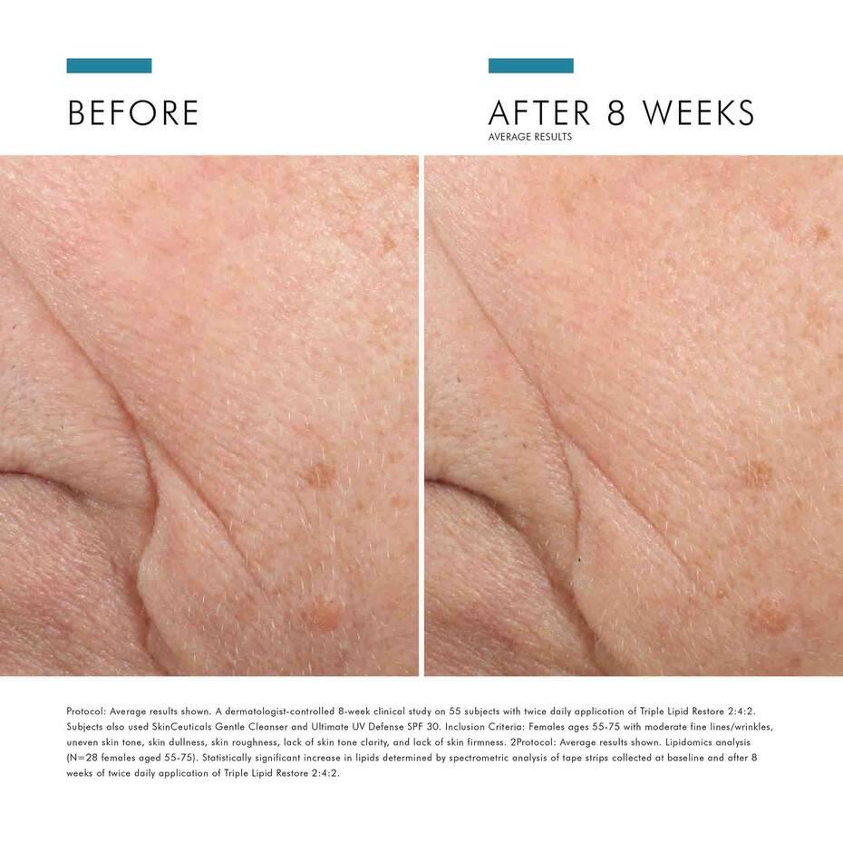 SkinCeuticals Triple Lipid Restore 2:4:2 - Geria Dermatology